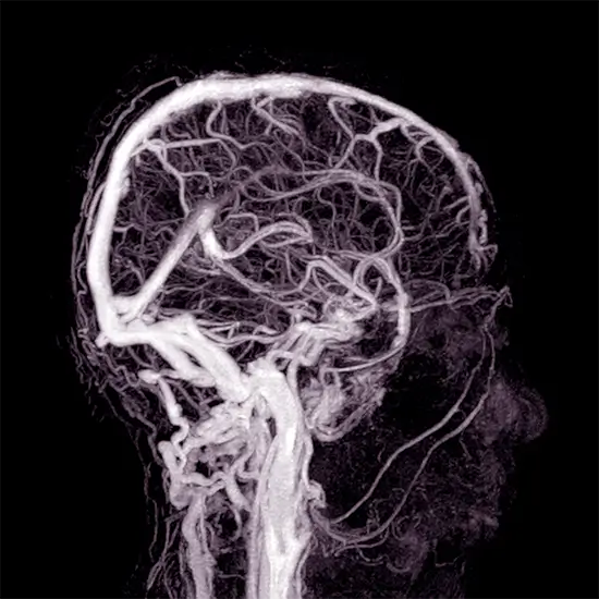CT Brain Angiography Test